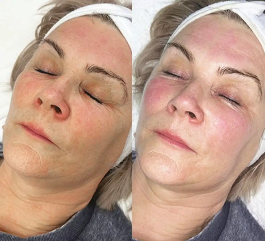 Hydrafacial before and after